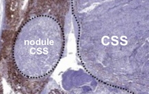 Deux microARN et leurs gènes cibles impliqués dans l’agressivité du carcinome corticosurrénalien